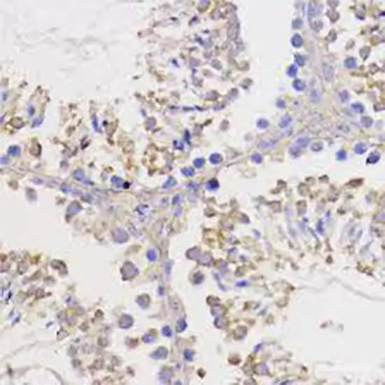 IHC - B-Cell Leukemia/Lymphoma 2